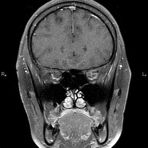 Optic nerve meningioma | Image | Radiopaedia.org