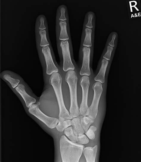 Xray Hand Anatomy