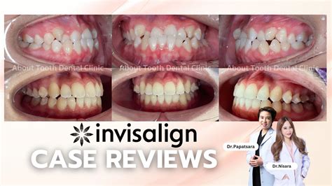 Invisalign Case Reviews - About Tooth Dental Clinic