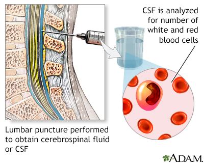 CSF cell count Information | Mount Sinai - New York