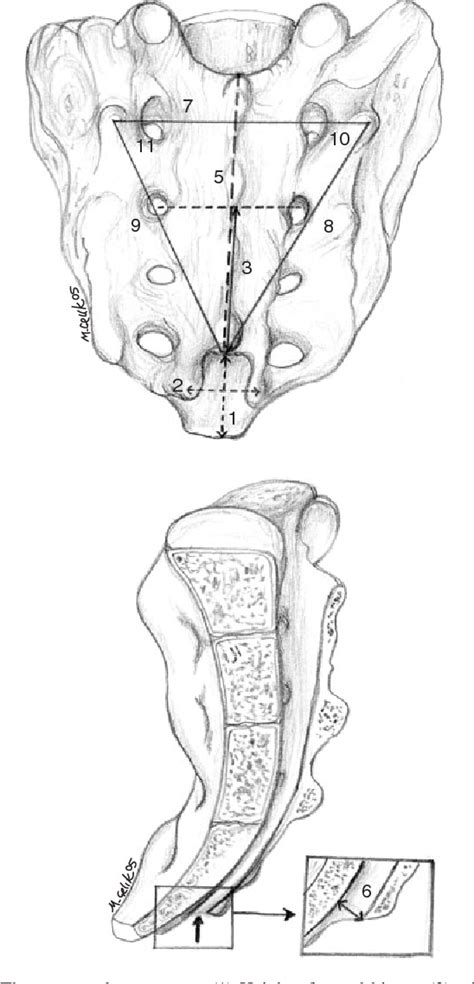 Figure 1 from Landmarks of the sacral hiatus for caudal epidural block ...