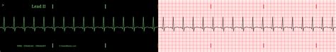 The Sinus Tachycardia EKG/ECG