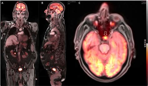 PET/MRI head scans reveal important incidental findings - ESHIᴹᵀ