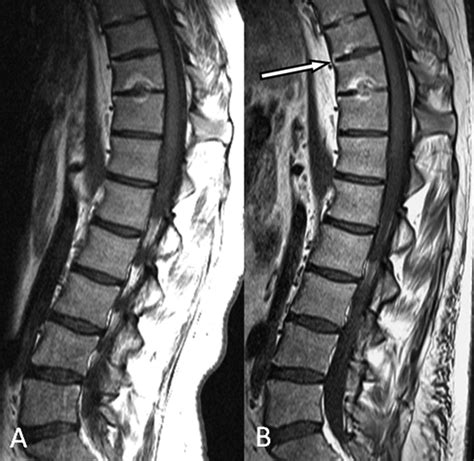 Ankylosing Spondylitis Mri