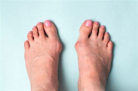 Sharp Pain in Feet: Symptoms of Arthritis in Toes – SAPNA Pain ...