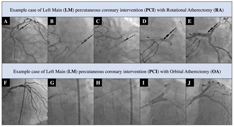 JCM | Free Full-Text | Comparison of Orbital Atherectomy and Rotational ...