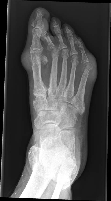 Gout | Radiology Case | Radiopaedia.org | Radiology, Radiology imaging ...