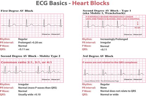 ECG Educator Blog : Heart Blocks