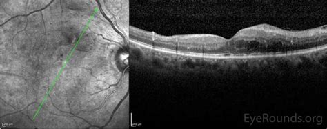 Diabetic Macular Edema