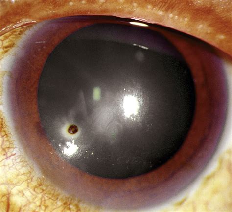 Corneal Rust Ring