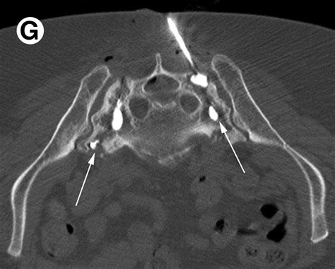 Sacroplasty - Techniques in Vascular & Interventional Radiology