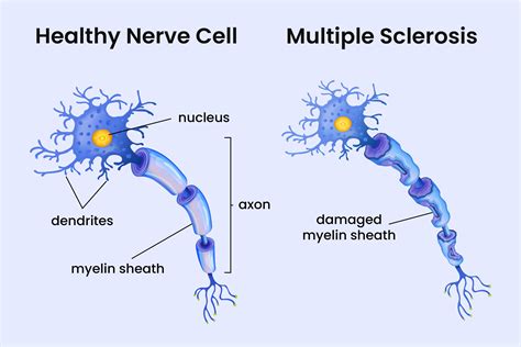 How Multiple Sclerosis (MS) Affects the Myelin Shealth