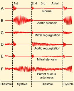 https://upload.wikimedia.org/wikipedia/commons/4/4a/Phonocardiograms_from_normal_and_abnormal ...