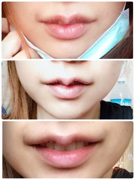 Kissable Lips Reshape Surgery by Dr. Aui