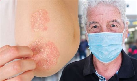 Coronavirus UK: COVID symptoms and signs of infection include heat rash on your skin | Express.co.uk