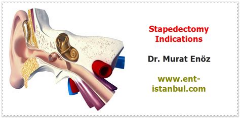 Stapedectomy Operation in Istanbul