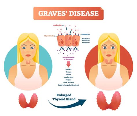 Grave's Disease : Overview, Causes, Symptoms, Treatment - illness.com