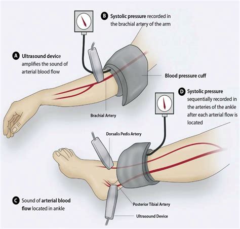 New Jersey Peripheral Arterial Disease Treatment