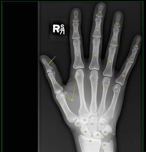 Hand Xray 2 (carpal bones) Diagram | Quizlet