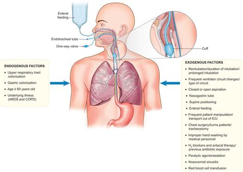 Microbiology of Ventilator-Associated Pneumonia | IntechOpen