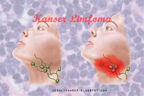 Apa Itu Kanser Limfoma (Lymphoma) | Kenali Kanser