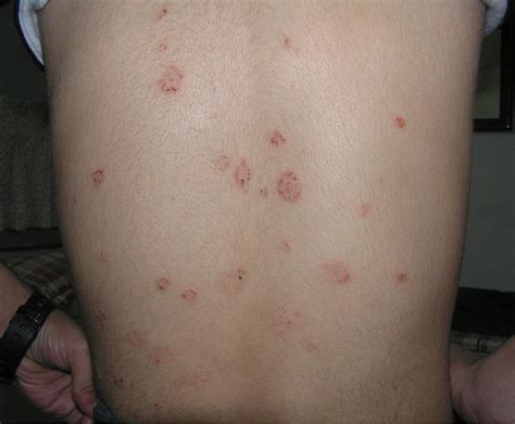 Pityriasis Rosea - Causes, Rash, Herald Patch, Stages, Treatment