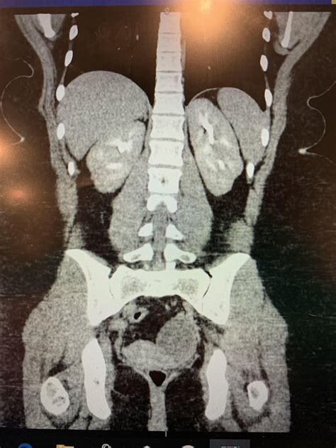 5.5 cm left ovarian cyst : r/XRayPorn