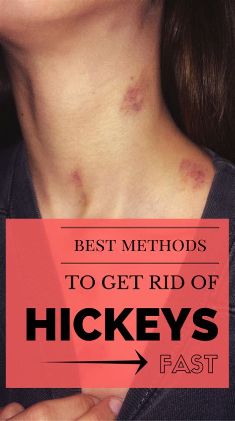 How To Remove Kiss Hickey - HOWTORMEOV