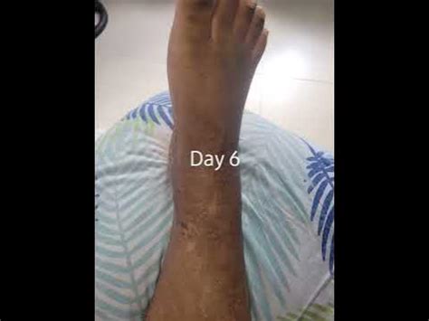 ORIF RIGHT ANKLE INCISION HEALING PICS AFTER REMOVAL OF CAST |DRY AND FLAKY SKIN - YouTube