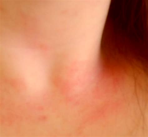 Lupus Rash – Pictures, Life Expectancy, Contagious, Symptoms, Treatment