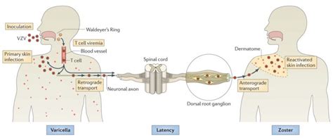 Varicella Zoster Virus- An Overview