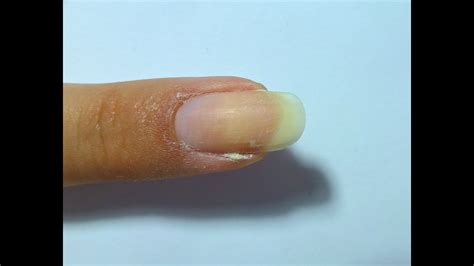 Hangnail