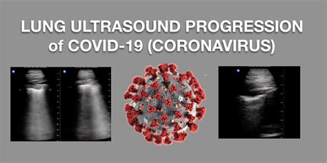 Lung Ultrasound Progression of COVID-19 Coronavirus - POCUS 101