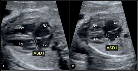 Atrial, Ventricular, and Atrioventricular Septal Defects | Obgyn Key