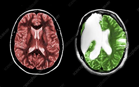 MRI of Normal Brain and Hemispherectomy - Stock Image - C027/2412 ...