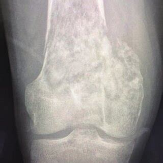 X-ray of distal femur osteosarcoma in a 22-year-old male patient ...