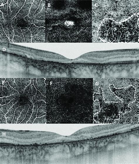 Optical coherence tomography angiography (OCTA) of patient No. 1.... | Download Scientific Diagram