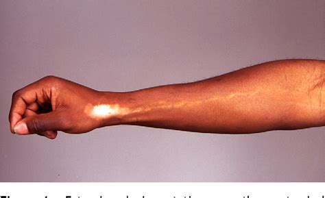 Ascending hypopigmentation of the forearm following injection of ...