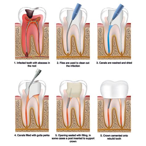 Root Canal Treatment - Dentist @ Parkside