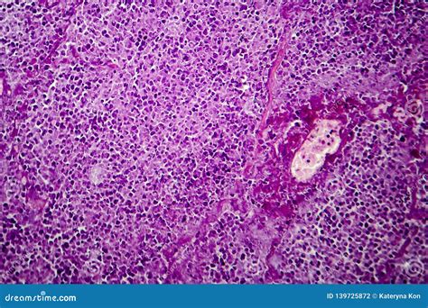 Tuberculosis Granuloma. Langhans Cell Royalty-Free Stock Photography | CartoonDealer.com #93292649