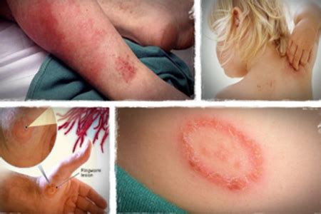 Herbal Remedies for Ringworm (Dermatophytosis, Tinea), Ayurvedic Treatment