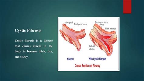 Ivacaftor and lumacaftor Drugs