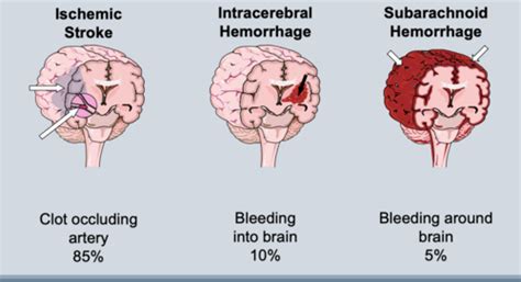 Cerebrovascular accident Flashcards | Quizlet