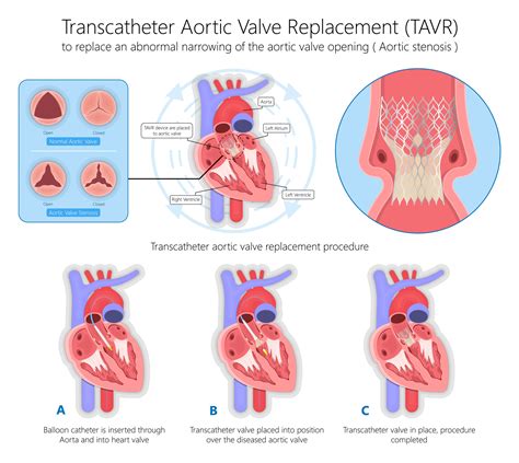 Aortic Valve Tavr Procedure