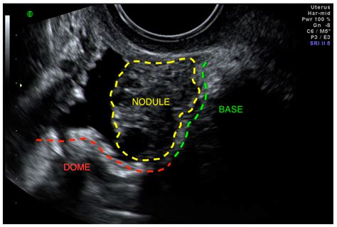 Endometriosis Transvaginal Ultrasound