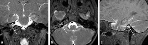 A 9-year-old boy with CSF otorrhea after head trauma. Coronal (a ...