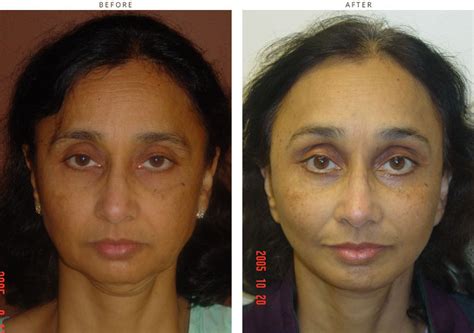 Mini Face Lift – Before and After Pictures * – Dr Turowski – Plastic ...