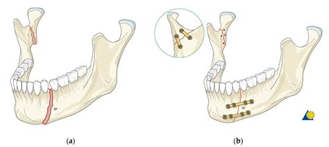 Materials | Free Full-Text | A Mandible with the Temporomandibular ...