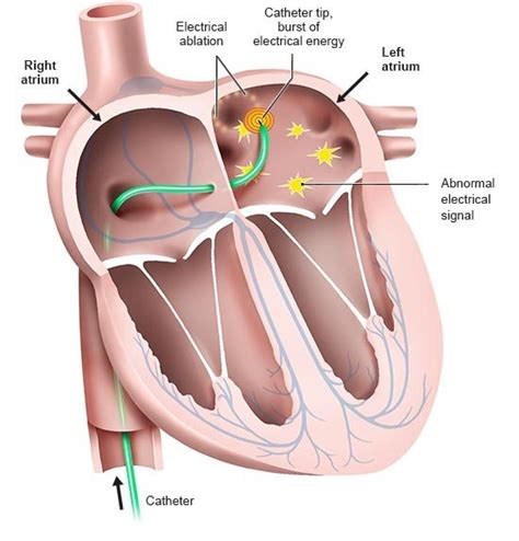 What happens during cardiac ablation? | informedhealth.org