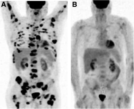 In Newly Diagnosed Diffuse Large B-Cell Lymphoma, Determination of Bone Marrow Involvement with ...